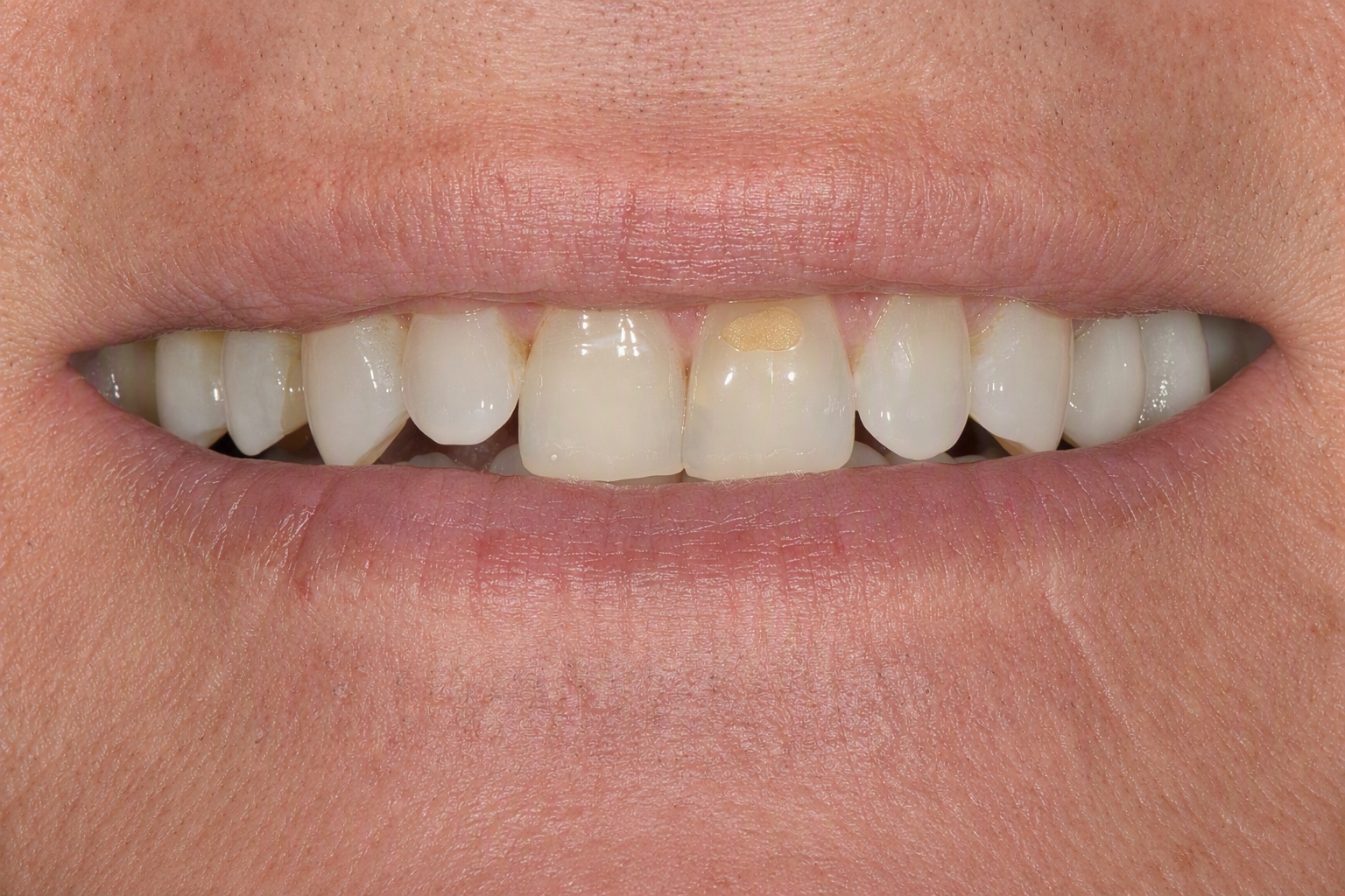 Smile before porcelain veneers, case 2