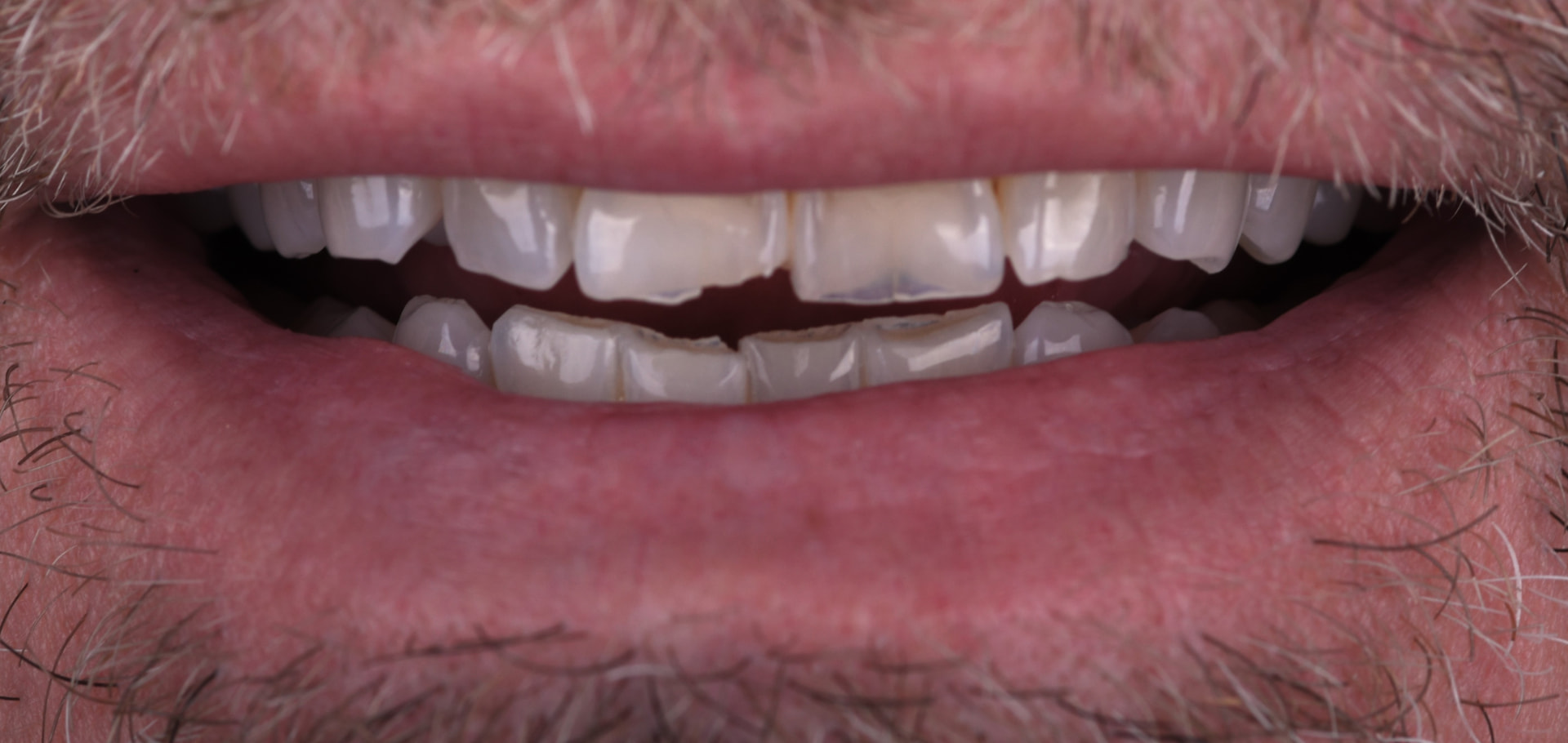 Smile before porcelain veneers, case 3