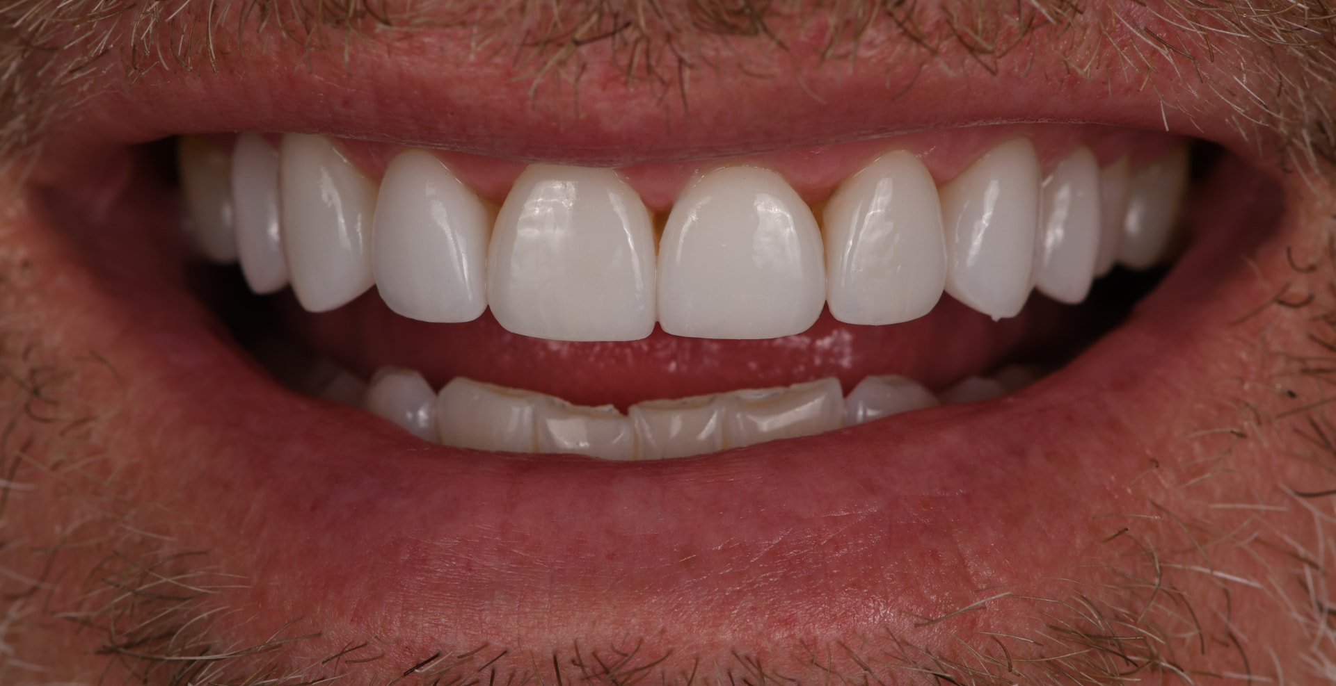 Smile after porcelain veneers, case 3