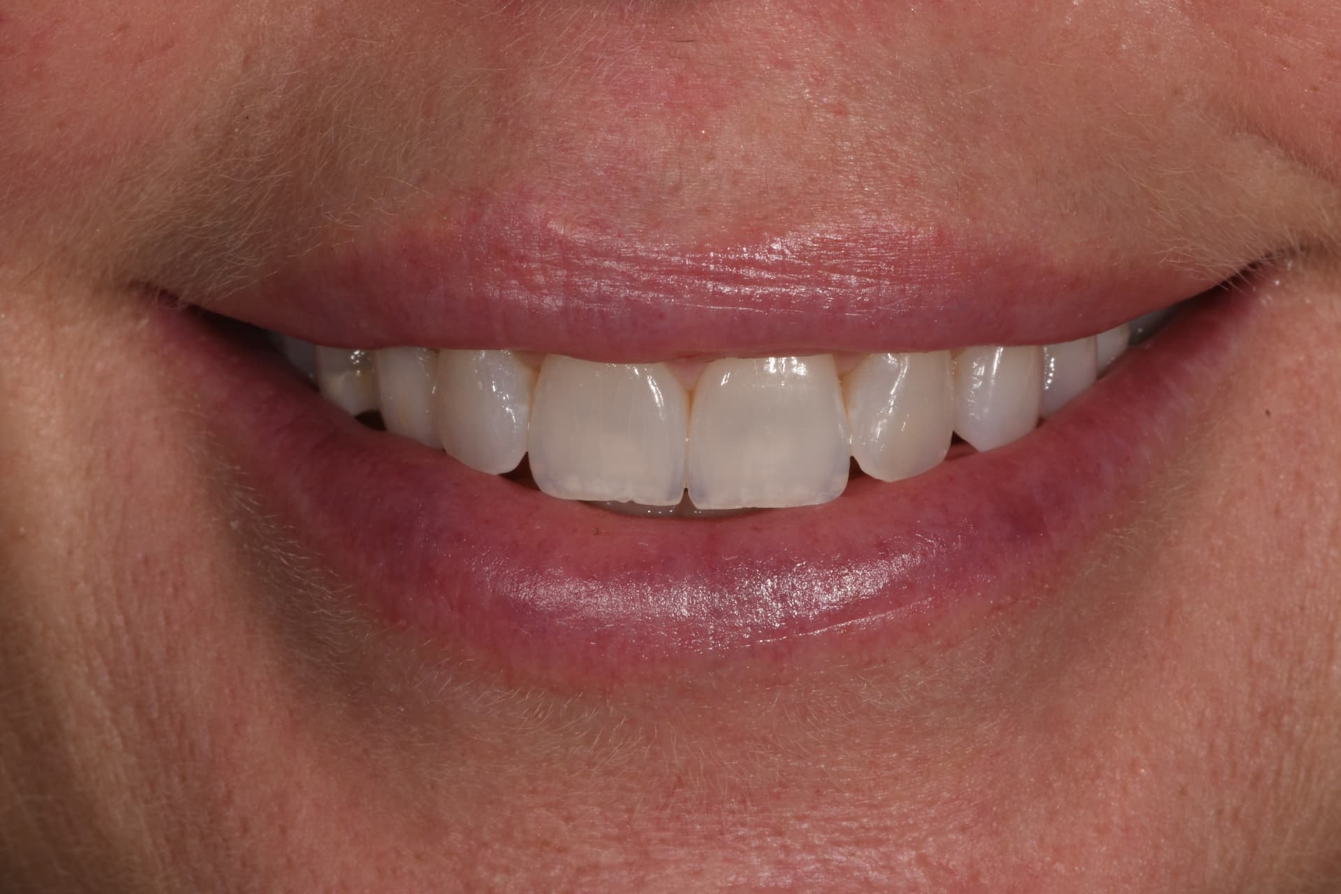 Smile before porcelain veneers, case 5