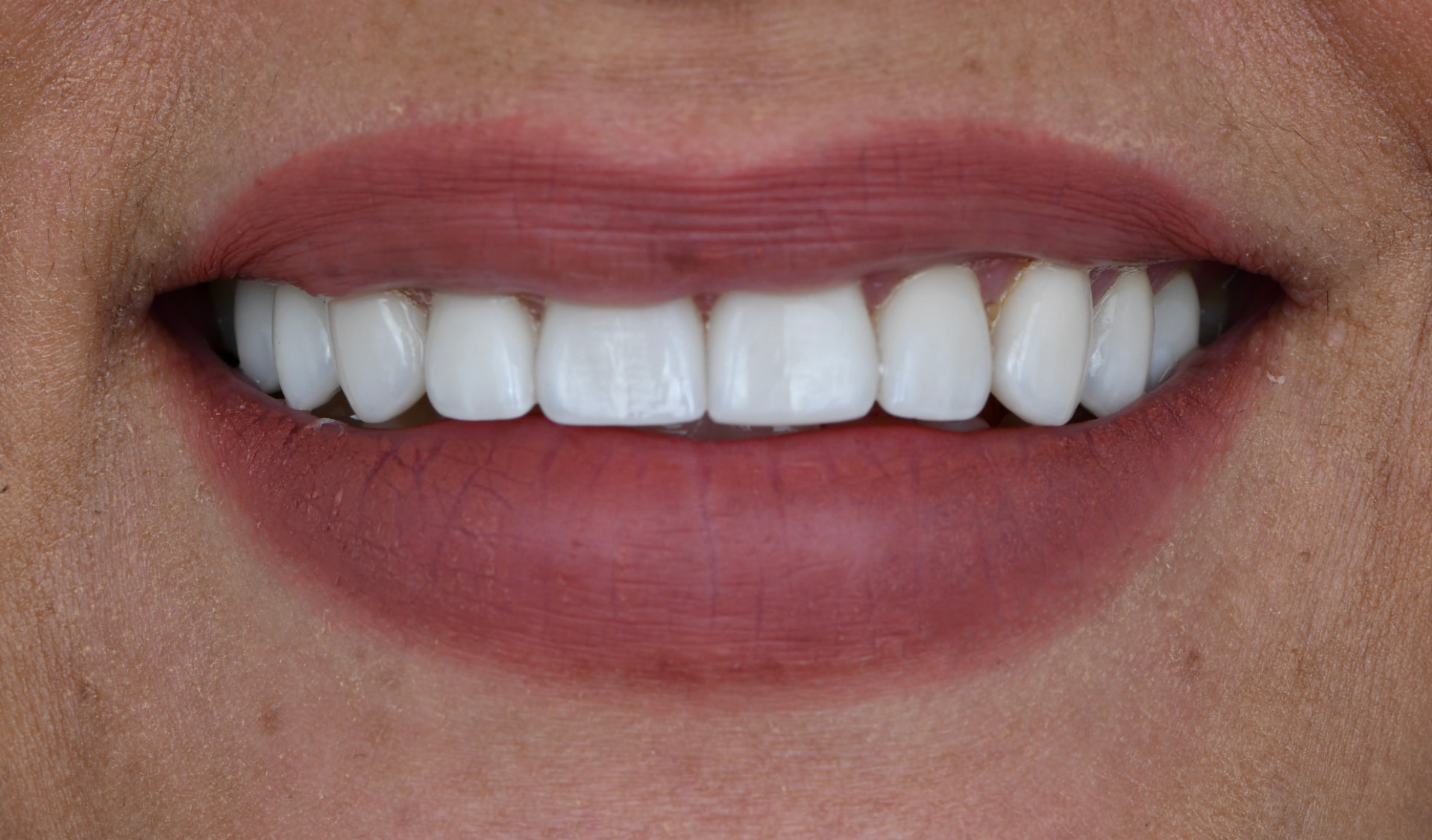 Smile after porcelain veneers, case 4