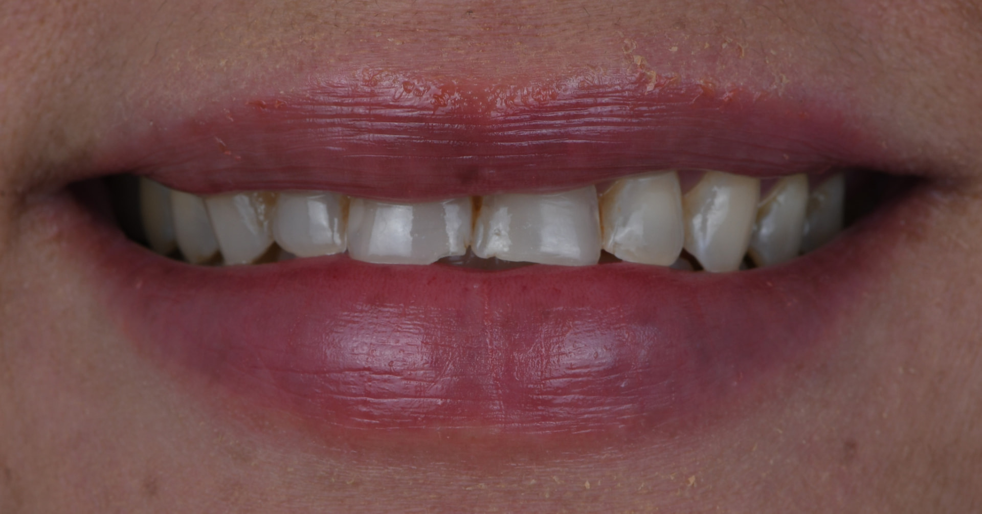 Smile before porcelain veneers, case 4