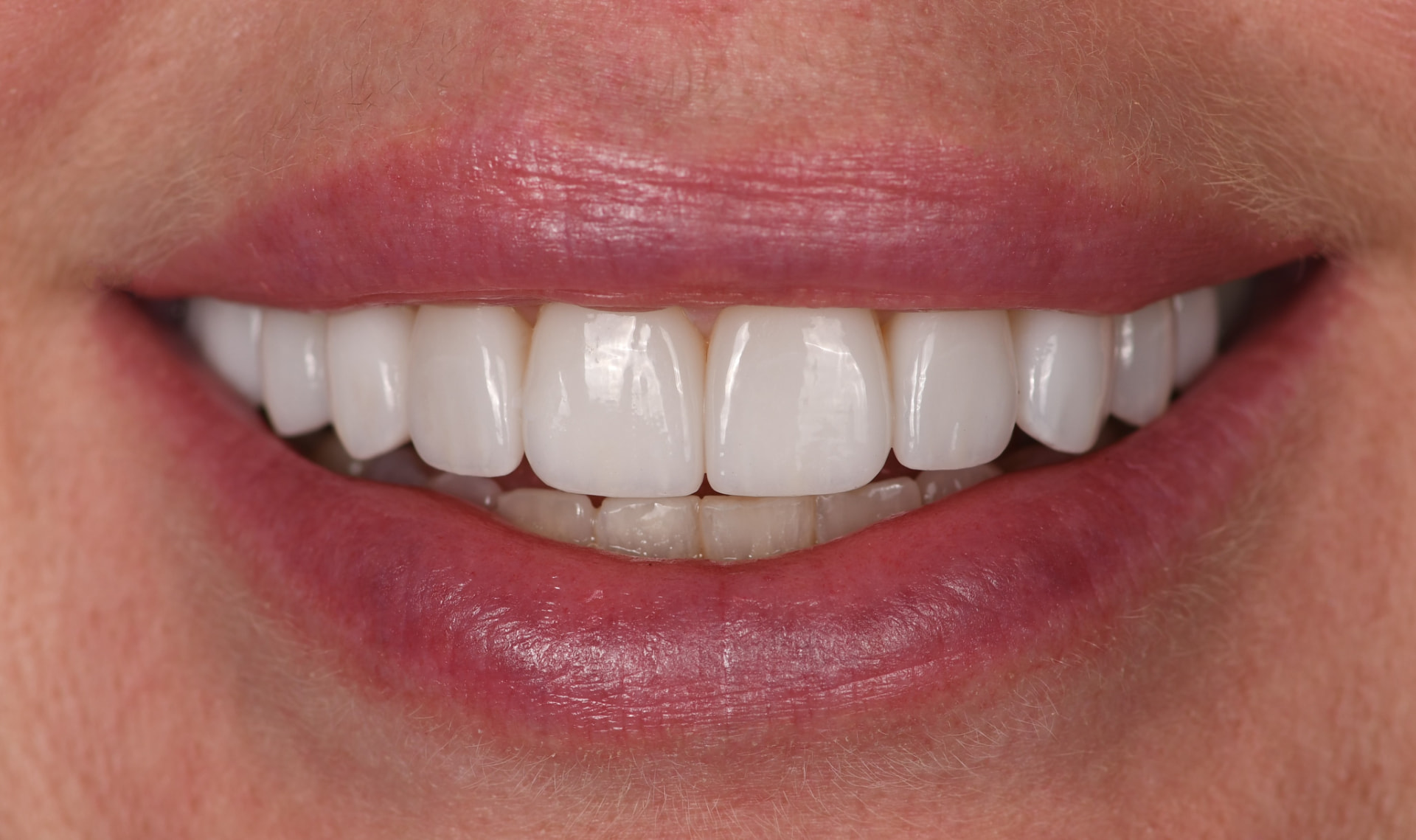 Smile after porcelain veneers, case 5