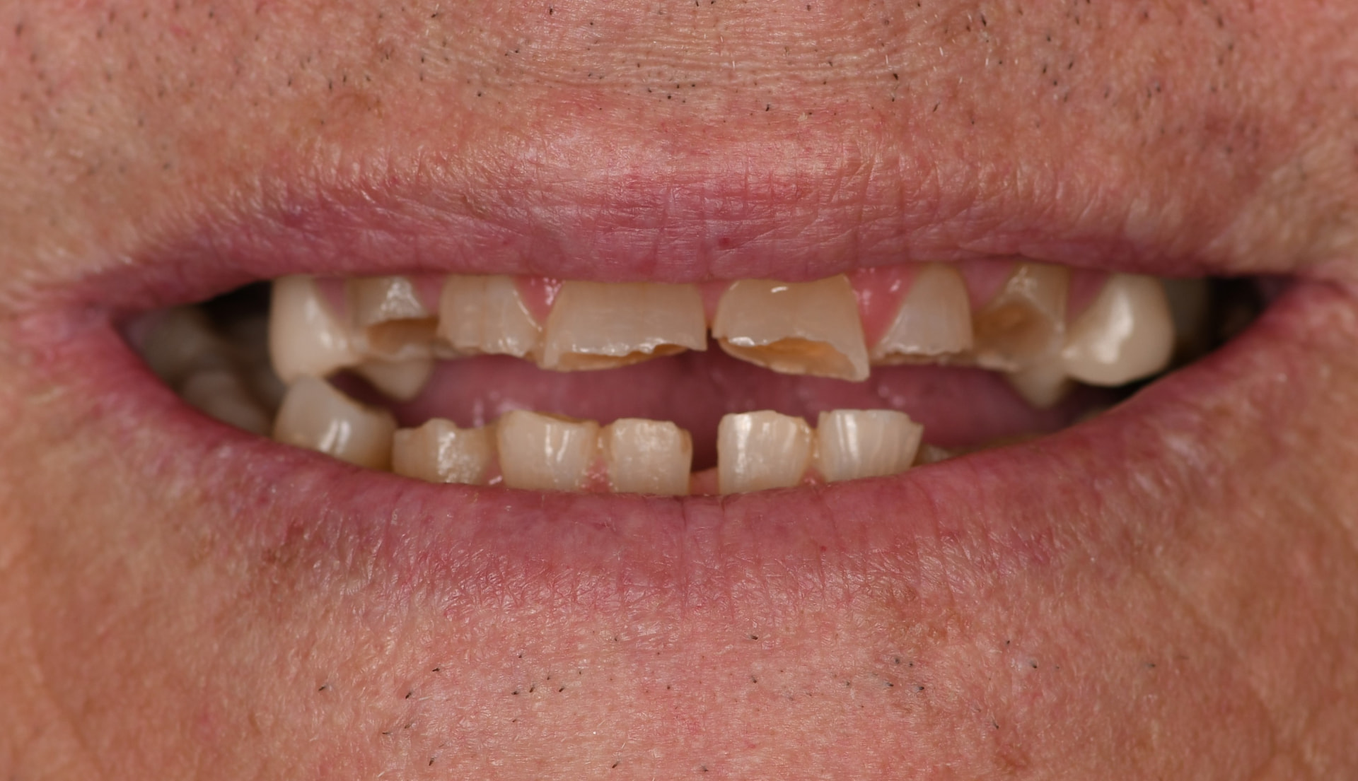 Smile before porcelain veneers, case 6