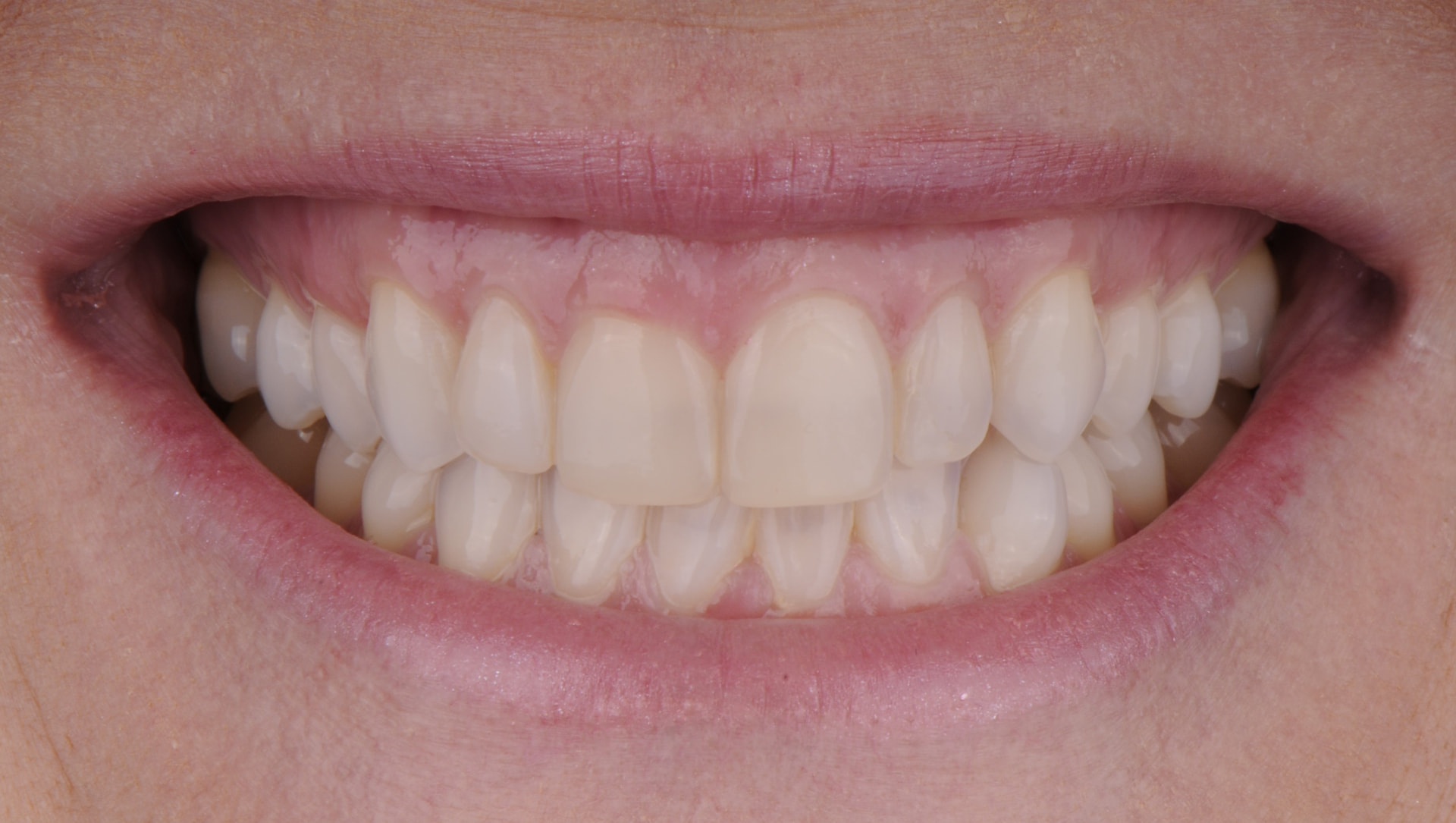 Smile before porcelain veneers, case 1