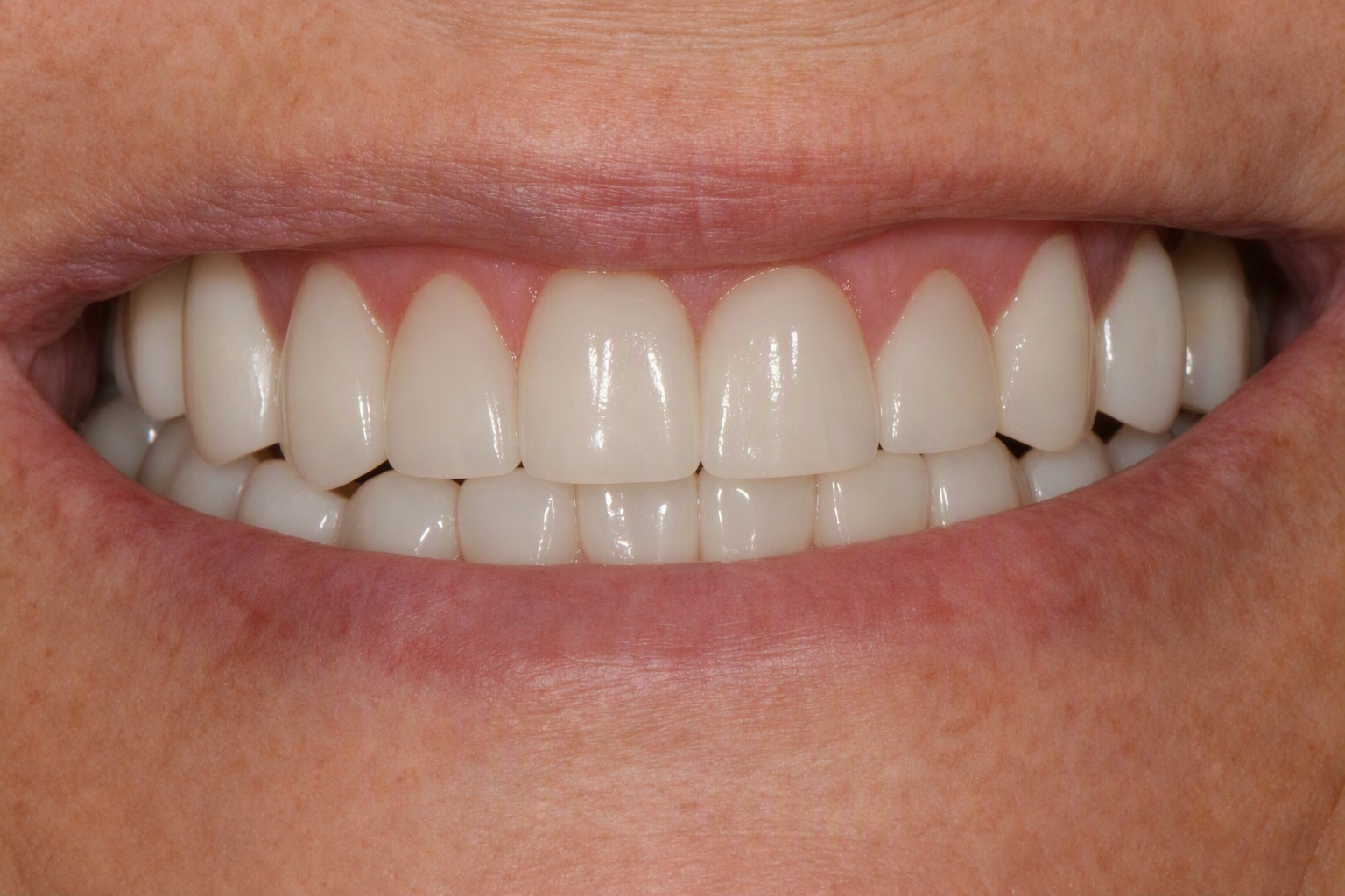 Smile after porcelain veneers, case 6