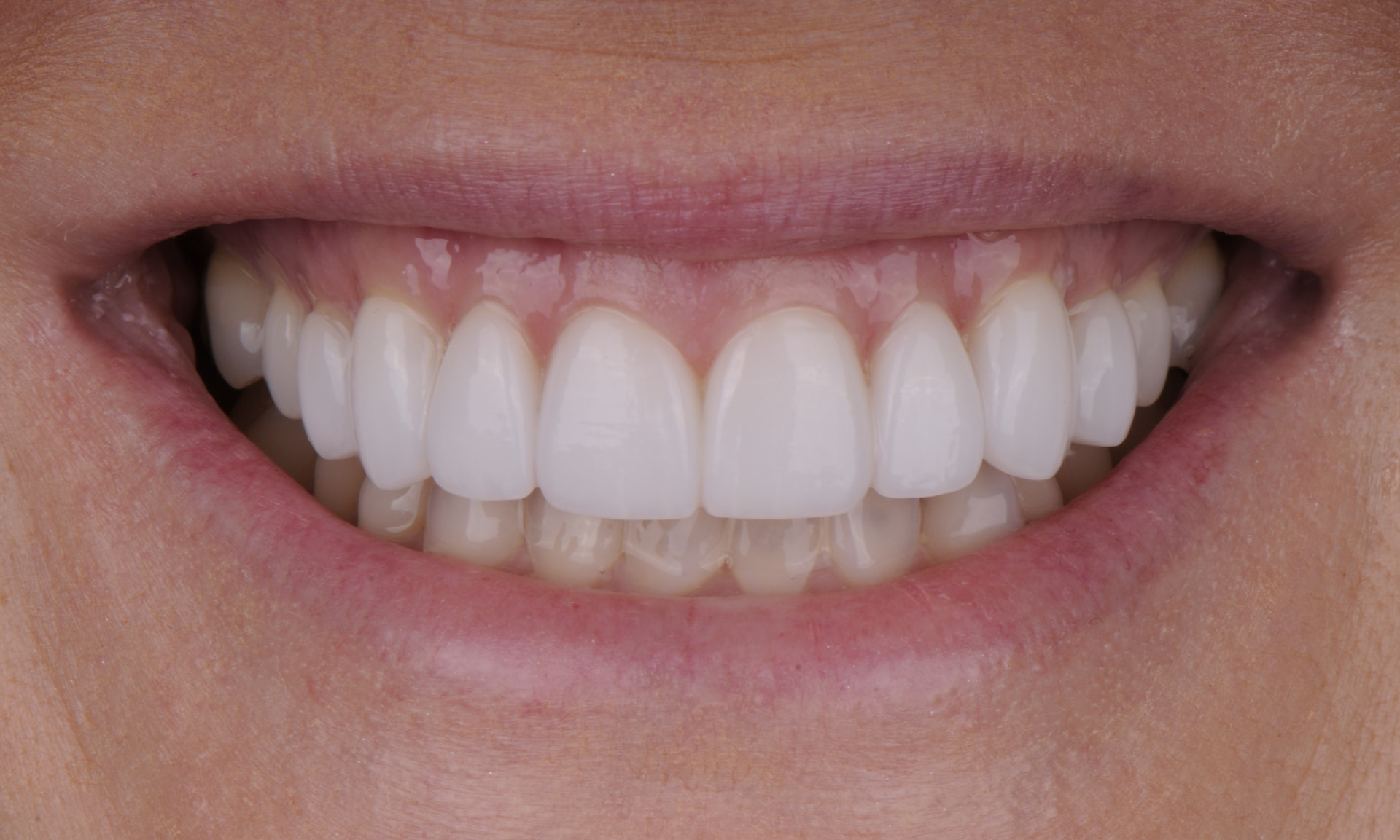 Smile after porcelain veneers, case 1