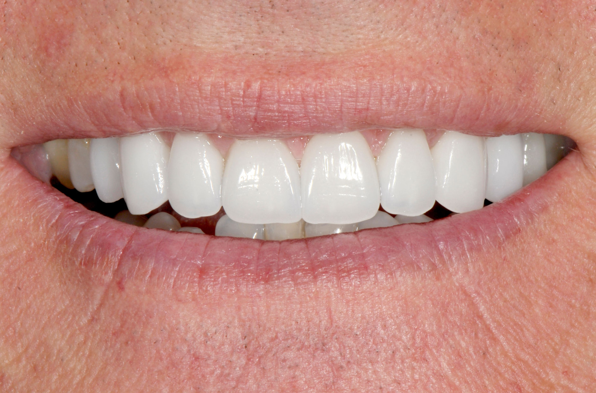 Smile after porcelain veneers, case 2